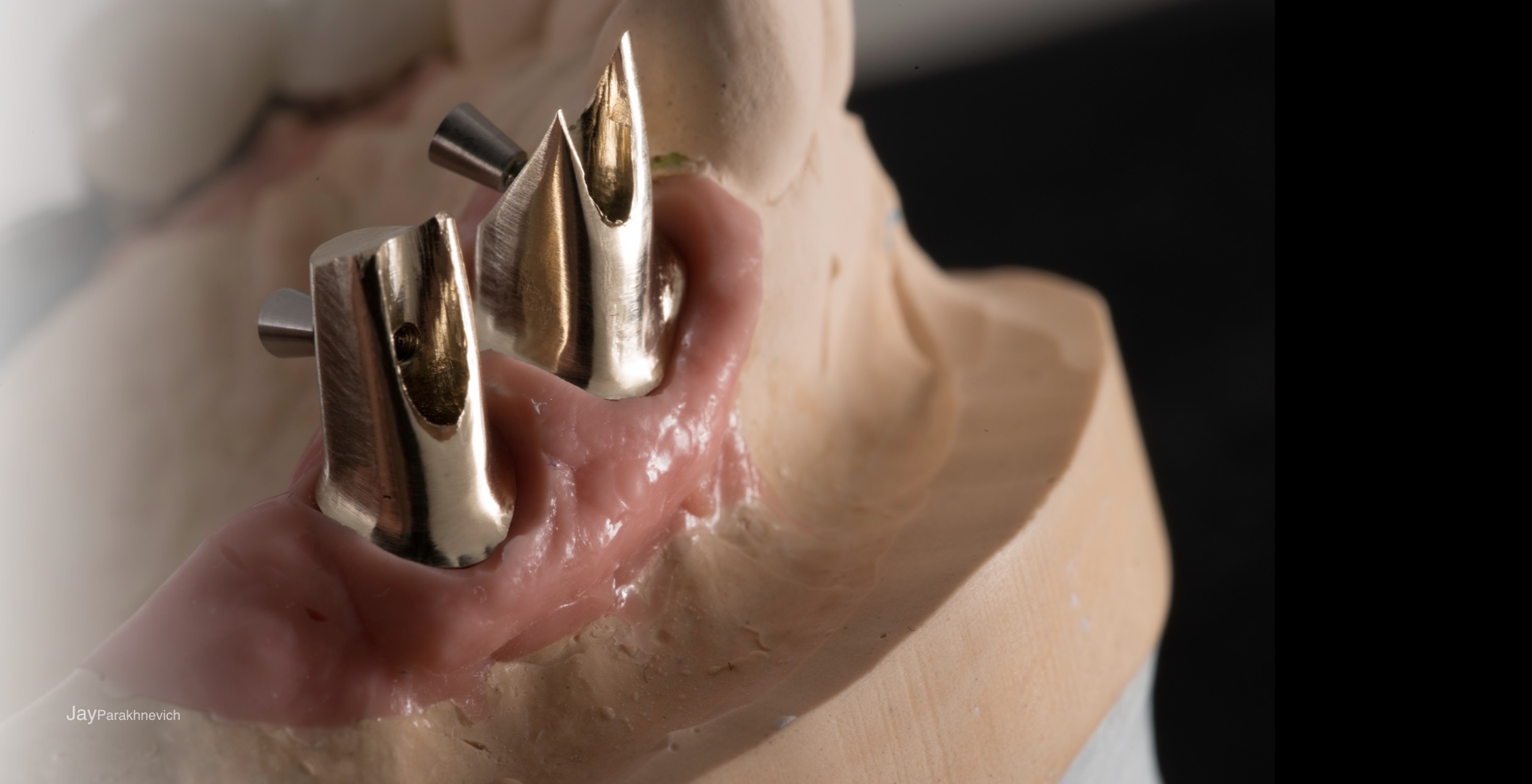 Implant Restoration